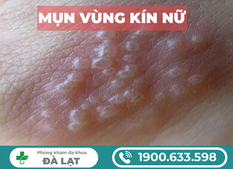 Hình ảnh minh họa